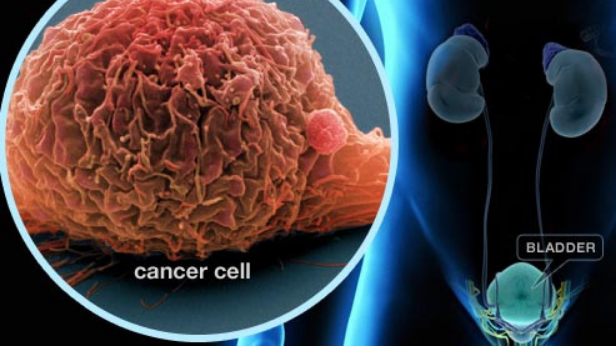 Bladder Cancer Treatment