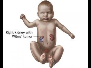Kidney Cancer