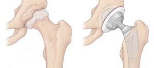 hip surgery