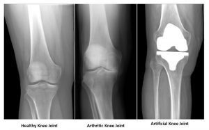 knee replacement