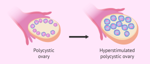 Fertility injections