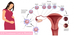 icsi treatment