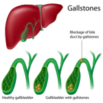 gall-bladder-and-gallstones-operation