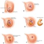 breast reduction