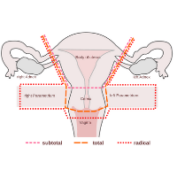 Vaginal Hysterectomy problems Treatment by Dr Siuli Choudhury