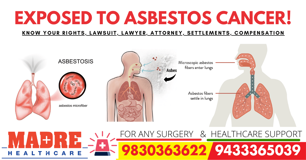 Exposed to Asbestos Cancer! Know Your Rights, Lawsuit, Lawyer, Attorney, Settlements, Compensation-min
