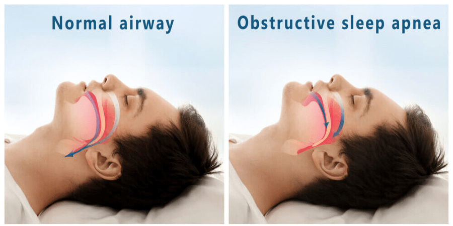 How to Stop Sleep Apnea