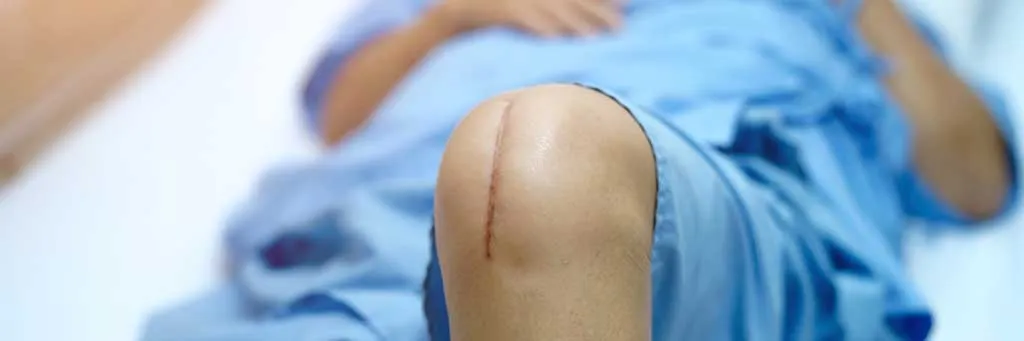knee replacement