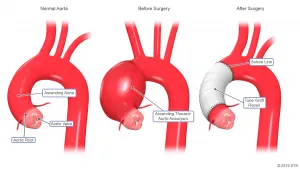 Aorta Aneurysm Graft 01