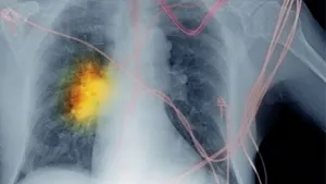 Lung Cancer