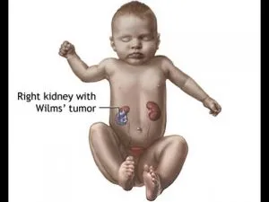 Kidney Cancer