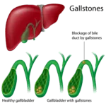 gall-bladder-and-gallstones-operation