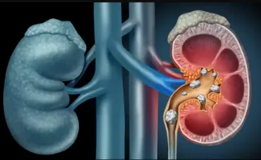 Kidney Stone Operation In India