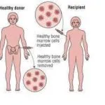 Bone Marrow Transplant
