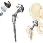 Hip Replacement Surgery
