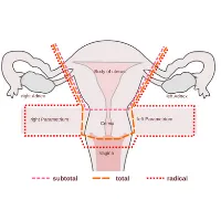 Vaginal Hysterectomy problems Treatment by Dr Siuli Choudhury